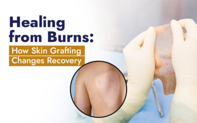 Healing from Burns: How Skin Grafting Changes Recovery 