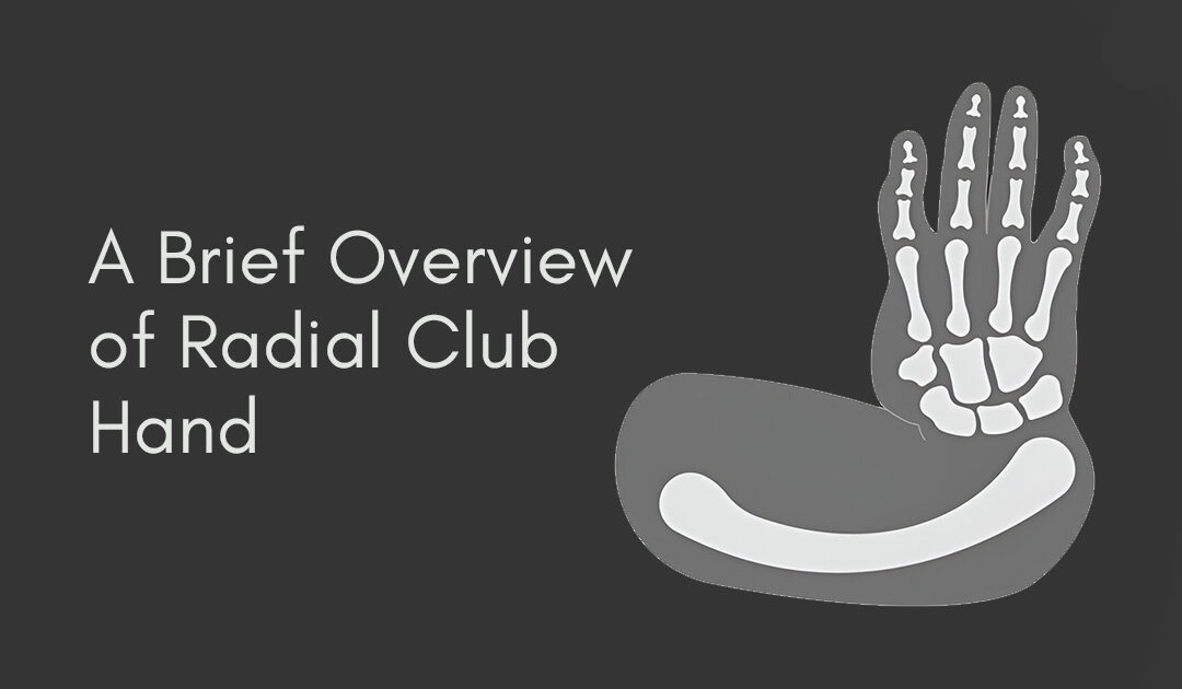  A Brief Overview of Radial Club Hand 