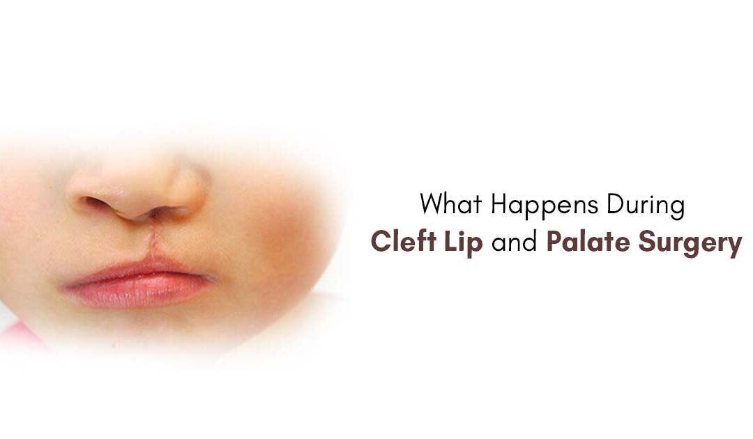 Cleft Lip and Palate Surgery