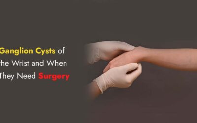 Ganglion Cysts of the Wrist and When They Need Surgery