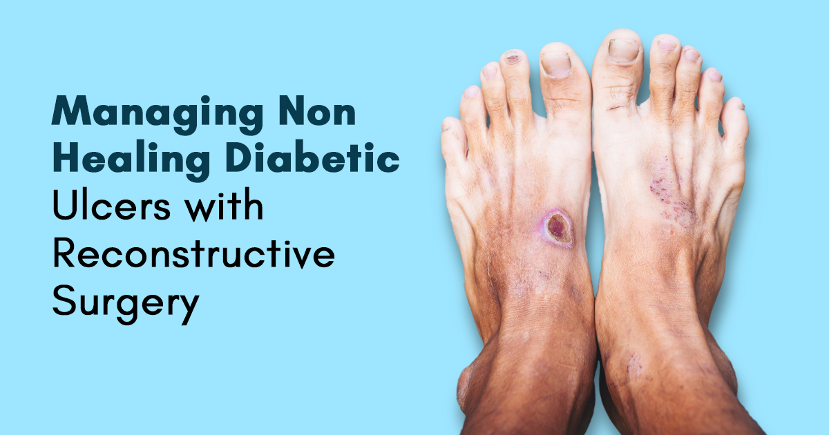 Managing Non Healing Diabetic Ulcers with Reconstructive Surgery
