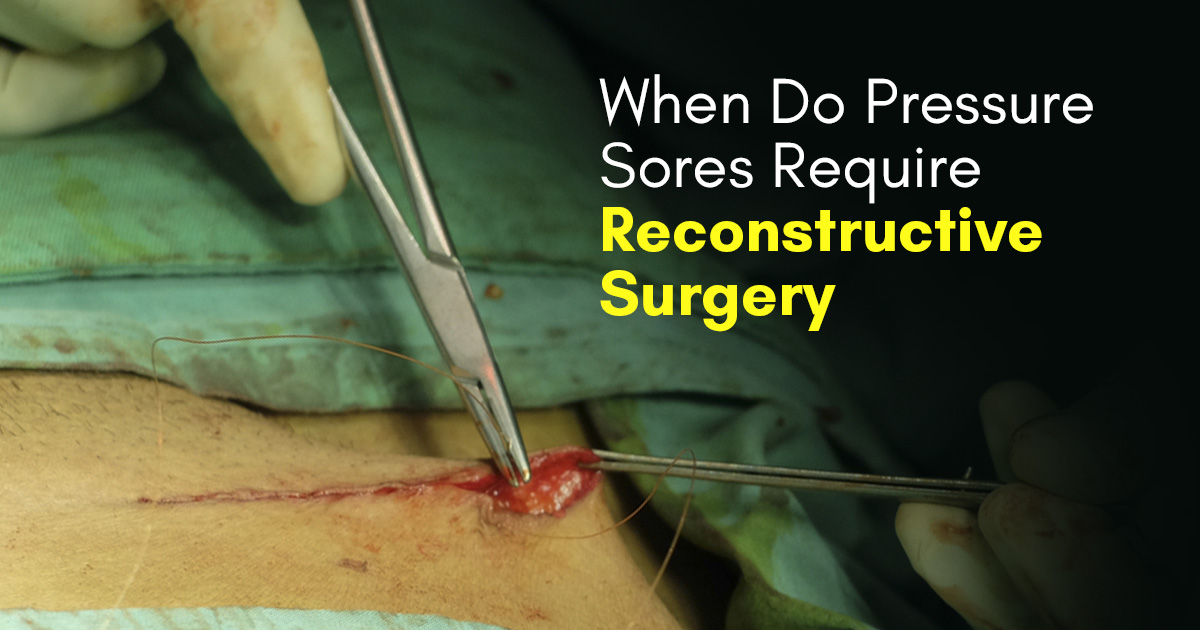 When Do Pressure Sores Require Reconstructive Surgery